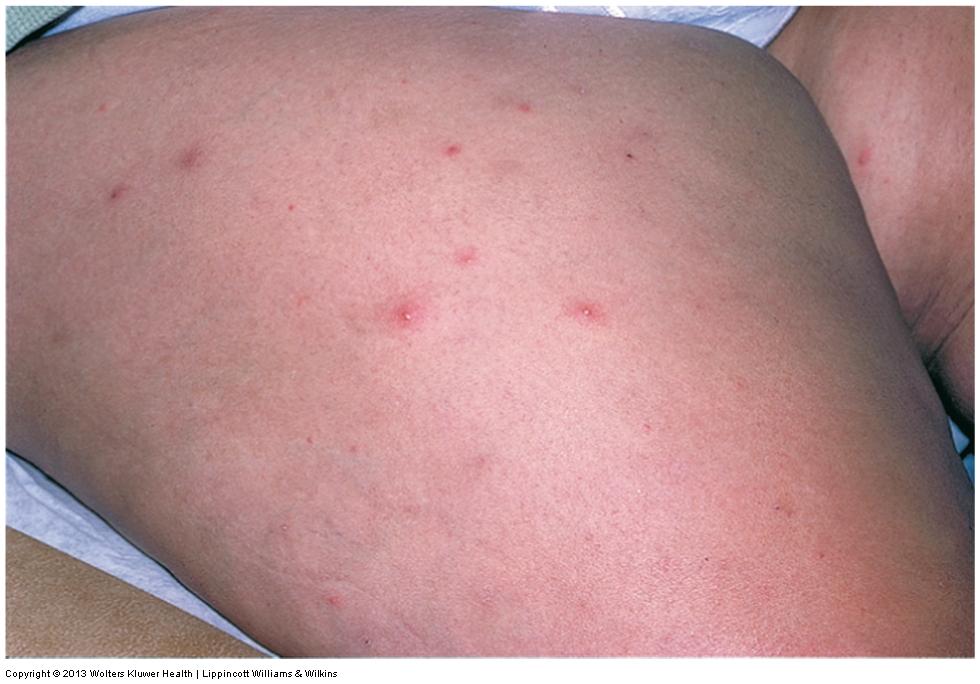 Contagious Skin Disorders! Folliculitis Multiple boils in close proximity usually affecting hair follicles.