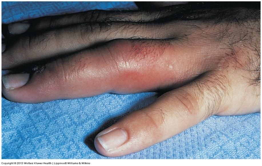 Contagious Skin Disorders Cellulitis Streptococcal infection of deep layers of the skin.