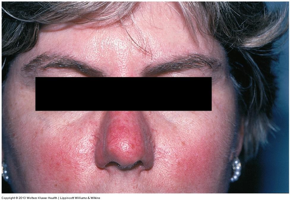 Non-Contagious Inflammatory Skin Disorders Acne rosacea Idiopathic chronic