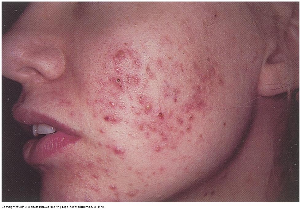 Non-Contagious Inflammatory Skin Disorders Acne vulgaris Small, localized skin lesions that usually affecting sebaceous glands on the