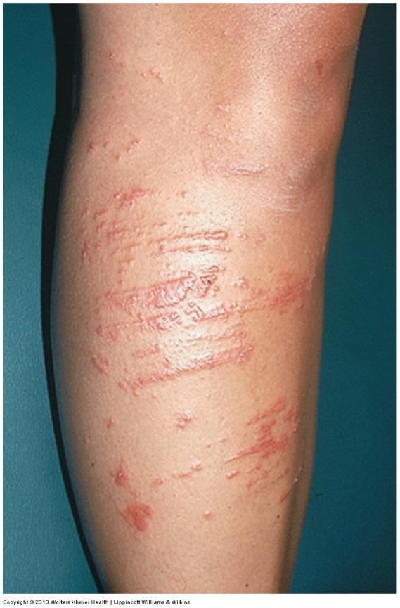Non-Contagious Inflammatory Skin Disorders Contact dermatitis Skin inflammation caused by