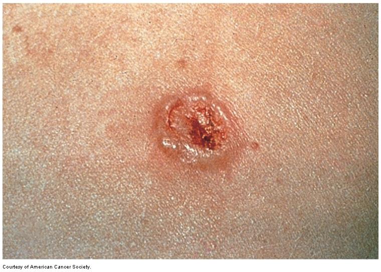 Neoplastic Skin Disorders Basal cell carcinoma (BCC) Most common type of skin