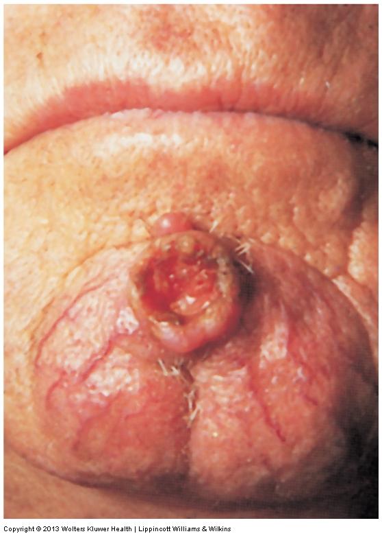 Neoplastic Skin Disorders Squamous cell carcinoma Skin cancer that