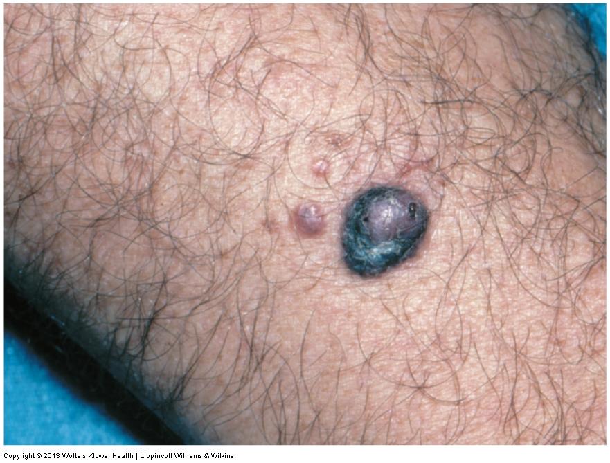 Neoplastic Skin Disorders Melanoma Cancer of the pigment cells deep in the
