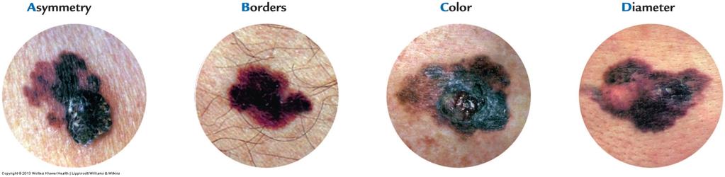 Neoplastic Skin Disorders ABCs of recognizing malignant melanoma:» Asymmetrical: irregular in shape»