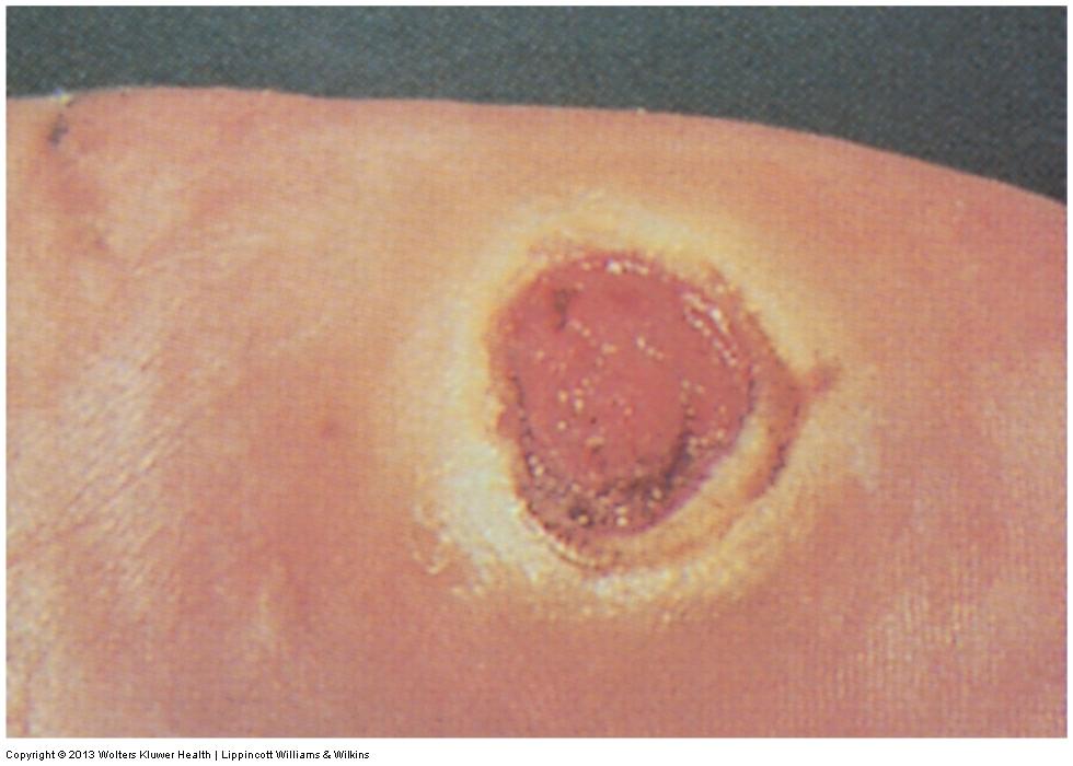 Skin Injuries Decubitus ulcer (AKA: bedsores, or pressure sores) Lesions caused by impaired circulation to the skin