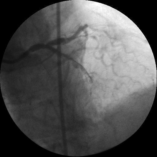 Aortic Stenosis LM, LAD,