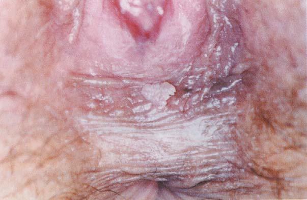 Clinical HPV s lesions Are defined those forms in which HPV S infection is clinically