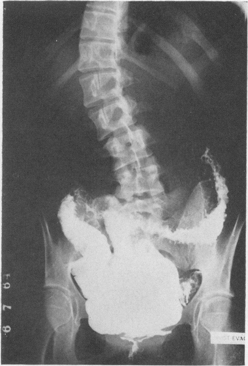 Crohn's disease of the colon 167 Case 14: barium enema (6.7.64) showing extensive FIG. 3c involvement of the colon in the post-evacuation film.