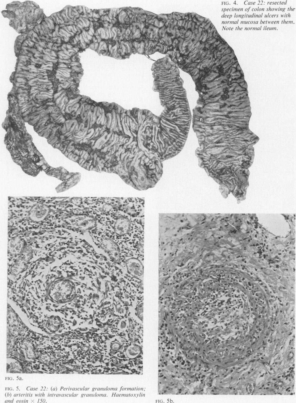 168 V. J. McGovern and S. J. M. Goulston FIG. 4. Case 22: resected specimen of colon showinig the deep longitudinal ulcers with normal mucosa between them. Note the normal ileum.