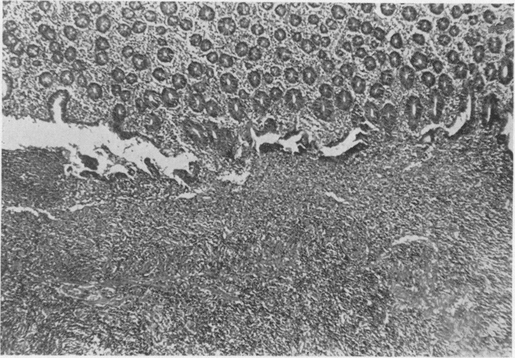 The floor of the ulcer has a granulomatouv appearance. Haematoxylin and eosin x 75. FIG.