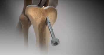 NOTE: While drilling over the Tibial Guide Pins, using a closed curette on top of the pin is recommended to ensure the pin does not advance too far into the joint.