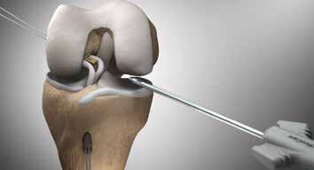 5 Once the Femoral Spacer is completely in the joint, do not reduce the femoral loop further.