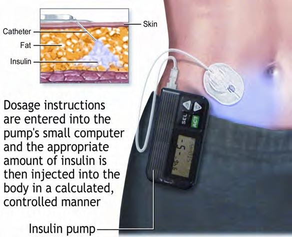 Getting started with your insulin pump The insulin pump is a device that gives insulin to the body at a steady rate. With the pump you won t need daily shots.  What does the pump look like?