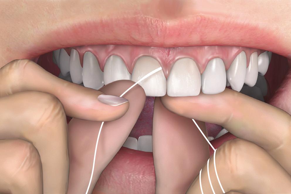 Proper Flossing Gently guide the floss
