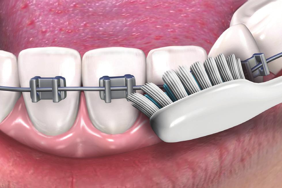 /MD Orthodontic Care GUM Orthodontic brushes are designed to clean both the tooth and orthodontic bracket. Use a short back and forth motion to clean both surfaces.