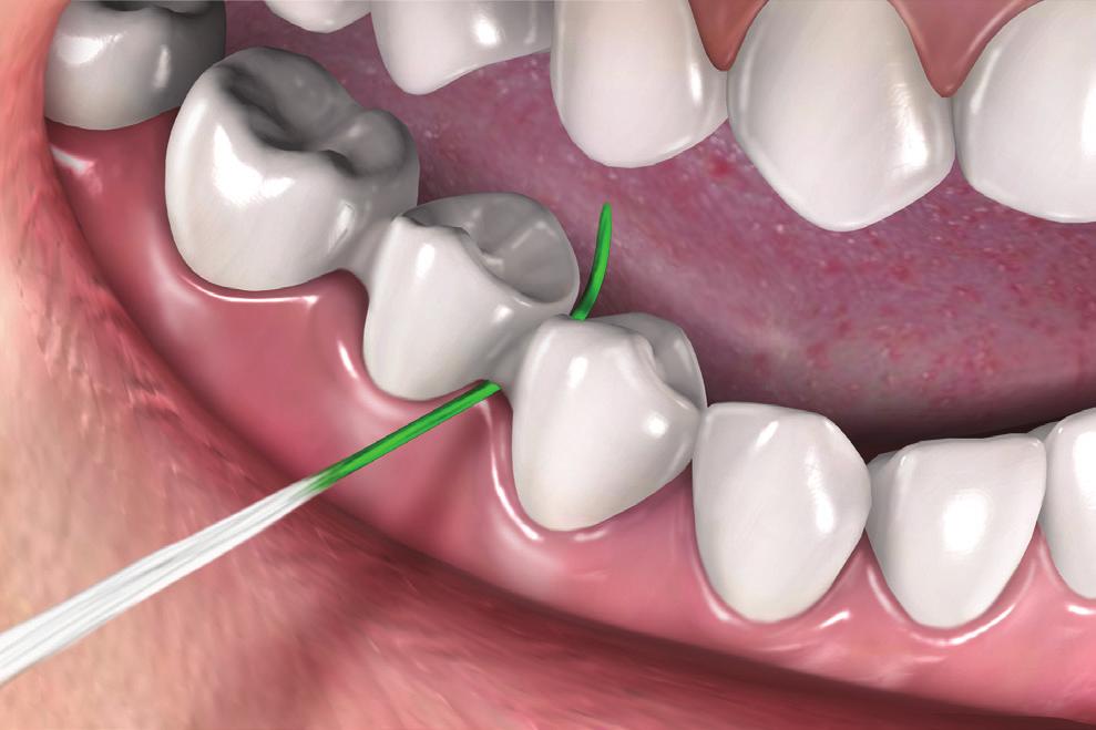/MD Bridge Care Use GUM Soft-Picks or GUM interdental brushes for larger spaces between bridged teeth. Select the proper size brush to fill the space.