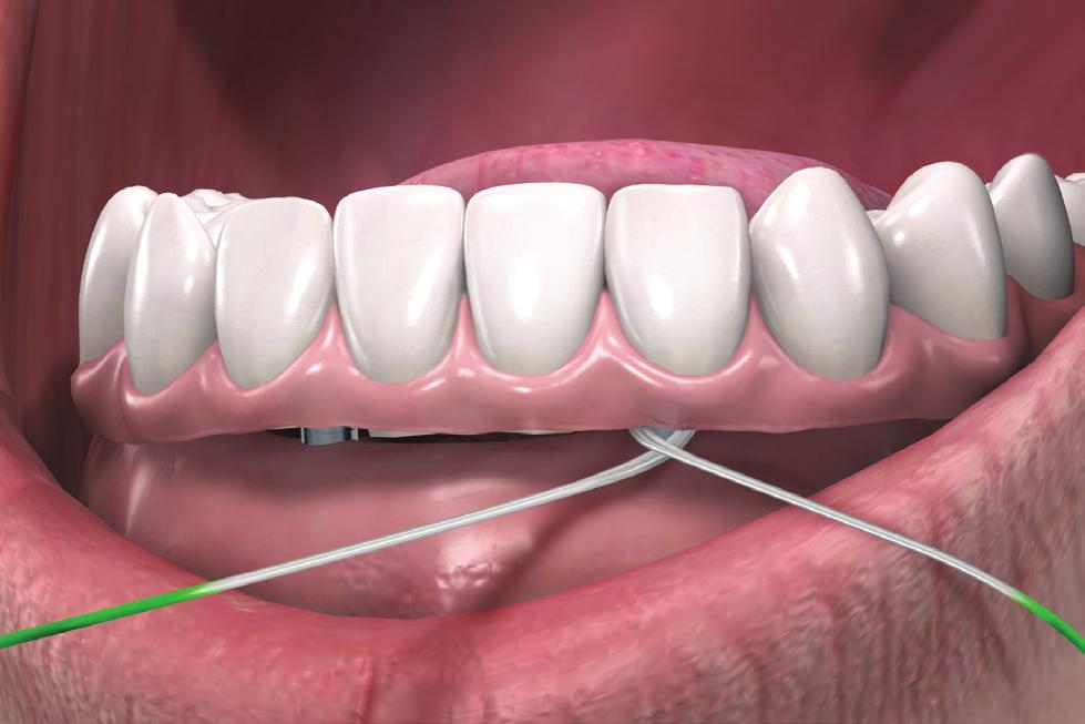/MD Implant Care Use GUM EasyThread Floss to clean implant posts. Insert the green threader end between posts and pull back through the other side of post. Grasp the free end and criss-cross cord.