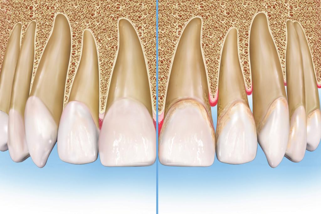 Healthy vs. Unhealthy Bone Healthy Bone Healthy bone is the supporting structure for the teeth.