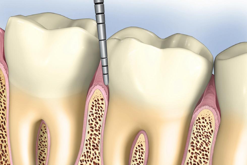 Periodontal Measurements A healthy sulcus is 0-3 mm deep. It can be cleaned easily by brushing and flossing.