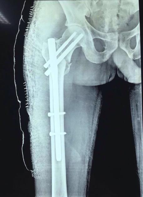 better fracture stability. Short PFN were used in the rest of cases. 88% of cases were treated closed and open reduction was done in cases where closed reduction was technically not feasible.
