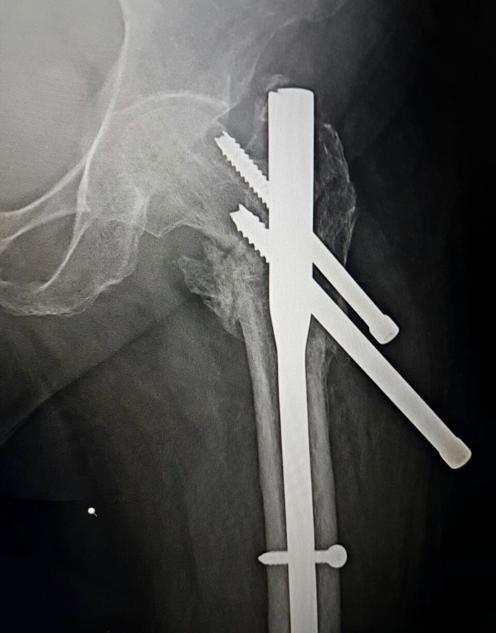 on Intramedullary hip screw for unstable intertrochanteric fractures (mean operative time 71 min), and Christian Boldin, Franz J Seibert et al (mean operative time of 68 min), the operative time in