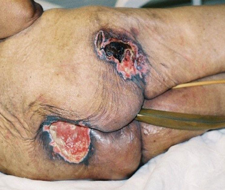 Exquisitely painful pressure ulcer of