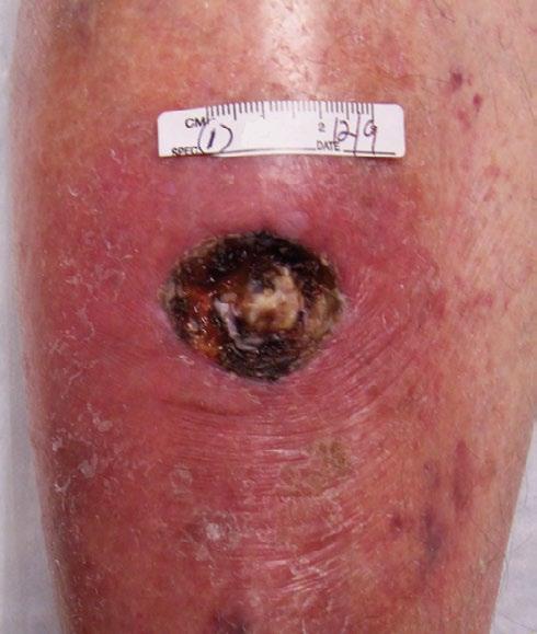 Acutely infected heel ulcer