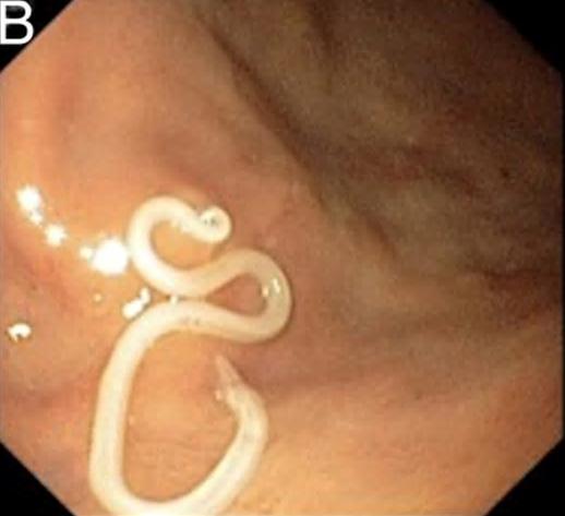 Case 1 Endoscopy revealed 2-3 cm long helminth