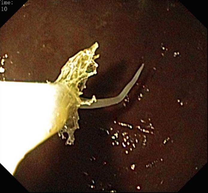 mucosa Endoscopic removal of larva with a Roth net