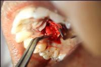 5mm of creeping attachment was seen mesially and 0.5 mm distally. The tissues appeared healthy and firmly attached to the tooth, pockets were absent and no bleeding on probing was present.