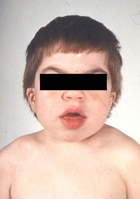 Hunter s Syndrome (MPS II) X-linked, iduronate 2-sulfatase deficiency Tissue deposits and excessive urinary excretion of