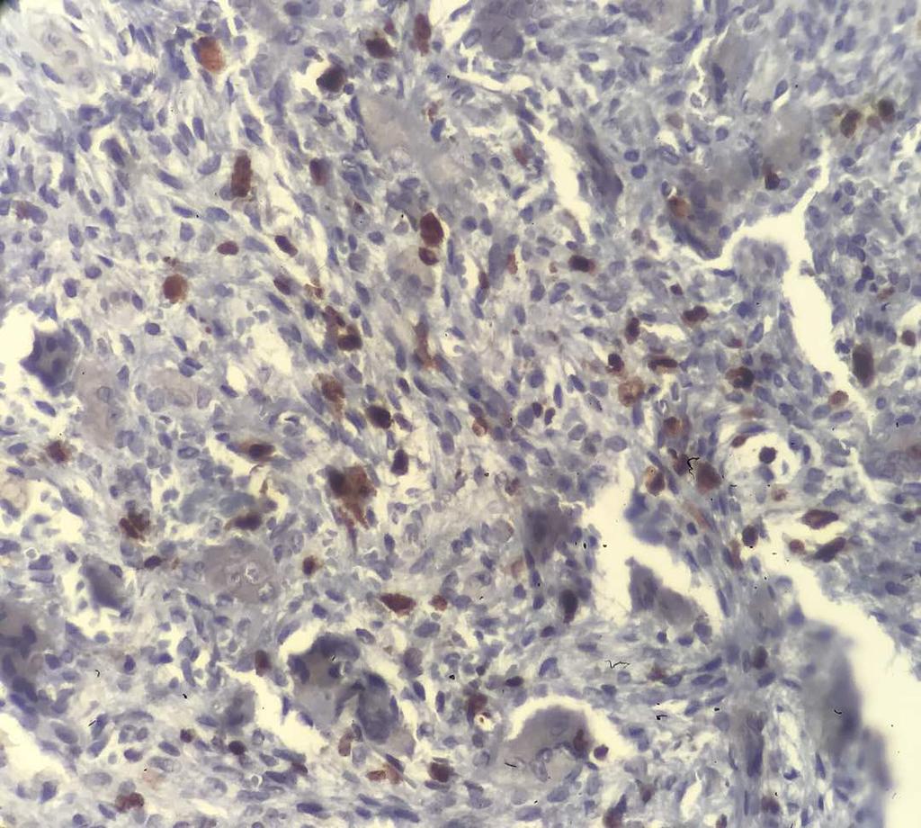9 Maximum 60 22 N 50 50 Central giant cell granuloma (CGCG) is considered a non-neoplastic lesion (Nevilel et al., 2016).