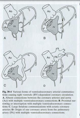 Coronary circulation (pathology) RV coronary sinusoid (60 70%) RV coronary connection (45 55%) Coronary