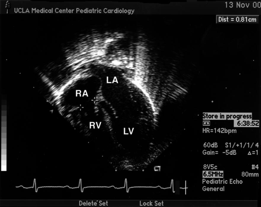 Echocardiography(TV evaluation)