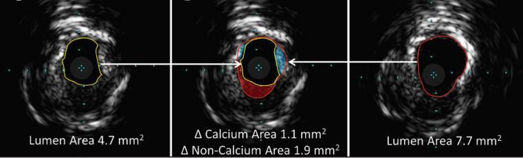 IVUS Images From JETSTREAM Calcium Study Pre and Post JETSTREAM Atherectomy 3 mm 2 gain in lumen CSA with