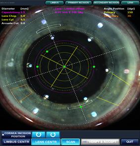 Improved Refractive Cataract Surgery Address Major Requirements for