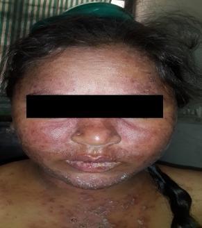 36%) 1.Malar rash: Malar rash is characterised by an erythematous rash over the cheeks and nasal bridge typically sparing the nasolabial folds [7].