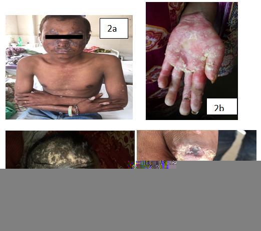Figure 2a. DLE lesions on face, ears, chest, arms, forearms and finger; 4b. DLE lesions on palms; 4c. DLE lesion on scalp with scarring alopecia; 4d.