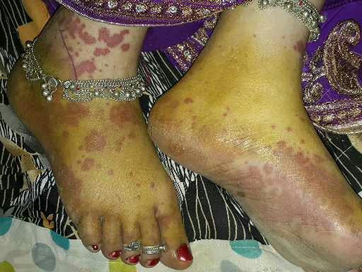 Small vessel vasculitis is commonly seen in SLE as leucocytoclastic vasculitis or palpable purpura in lower limbs.
