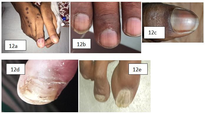 Figure12a. loss of nail following bullous lesion; 12b. Disruption of cuticle; 12c. Black pigmentation of nails; 12d. Nail fold necrosis; 12e. Ridging of toe nail V.