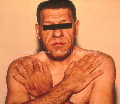 Acromegaly A chronic metabolic disorder in which there is too much growth hormone and the body tissues gradually enlarge.