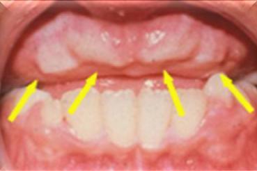 Other Manifestations Delayed eruption of teeth Microdontia