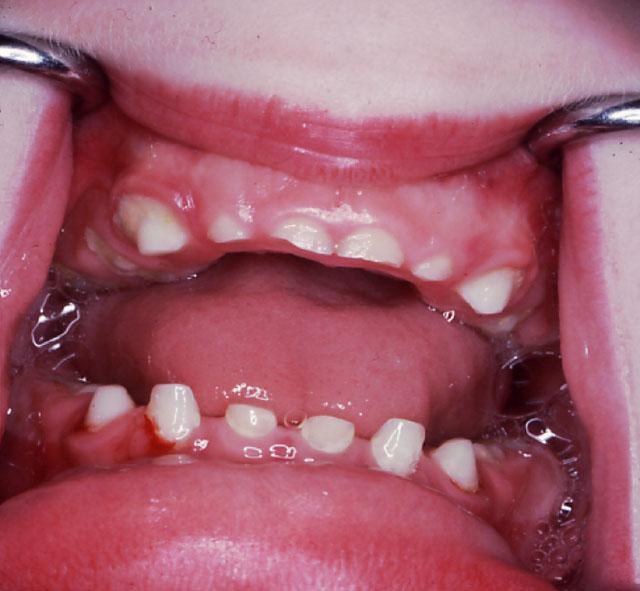 accommodate all the teeth, thus irregularity of teeth