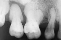 Gigantism (Oral manifestations) Prognathic mandible, dental malocclusion and