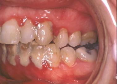 Aggressive Periodontitis Periodontitis as a manifestation of Systemic Disease Localised Generalised Associated with genetic disorders Not otherwise specified Gingival diseases of specific bacterial