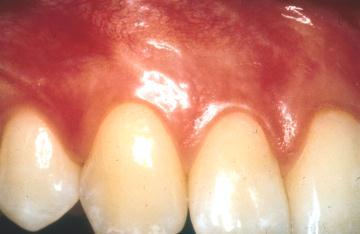 affecting at least 3 permanent teeth (other than first molars