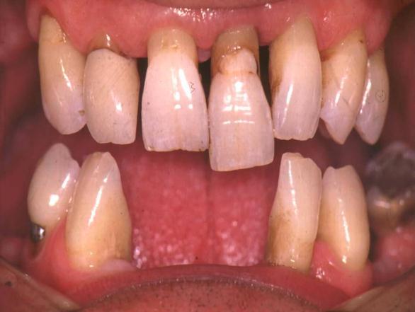 5mm) Gingival inflammation & bleeding Pocketing Gingival recession Tooth mobility / migration Attachment loss Conduct and document BPE Examine the occlusion (3.5-5.5mm) (0.