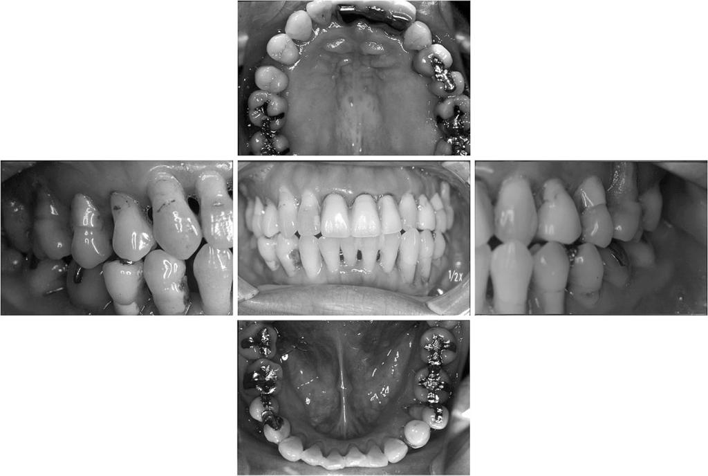 218 Kinumatsu T et al. Fig. 1 Oral view at baseline Introduction The onset of periodontal disease is associated with the presence of bacteria in plaque biofilm 11).