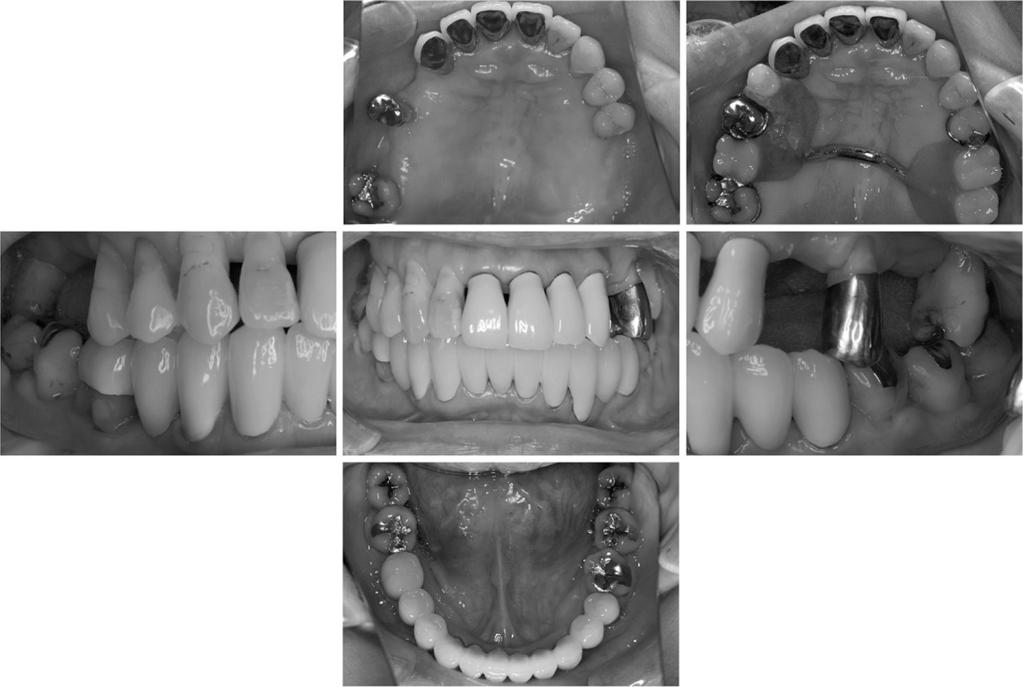 Prosthetic Treatment for Periodontitis 221 Fig. 4 Periodontal regenerative therapy with EMD (#36, 37) Fig. 5 Tunneling procedure (#46) Fig.